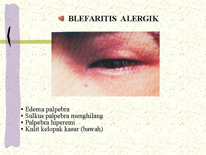 BLEFARITIS ALERGIK • Edema palpebra • Sulkus palpebra menghilang • Palpebra hiperemi • Kulit BLEFARITIS ALERGIK • Edema palpebra • Sulkus palpebra menghilang • Palpebra hiperemi • Kulit