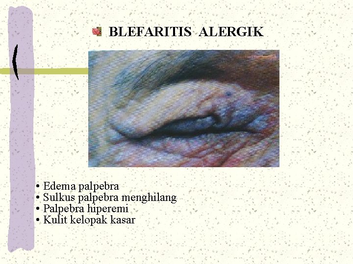 BLEFARITIS ALERGIK • Edema palpebra • Sulkus palpebra menghilang • Palpebra hiperemi • Kulit BLEFARITIS ALERGIK • Edema palpebra • Sulkus palpebra menghilang • Palpebra hiperemi • Kulit