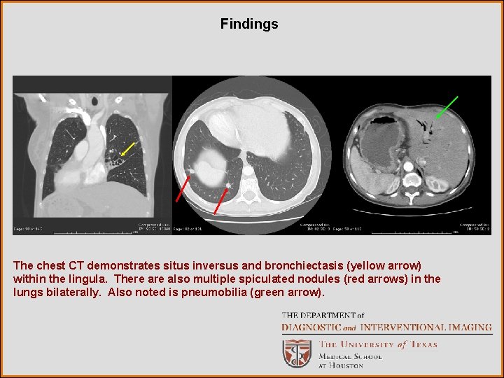 Findings The chest CT demonstrates situs inversus and bronchiectasis (yellow arrow) within the lingula.