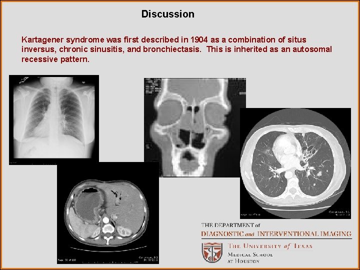 Discussion Kartagener syndrome was first described in 1904 as a combination of situs inversus,