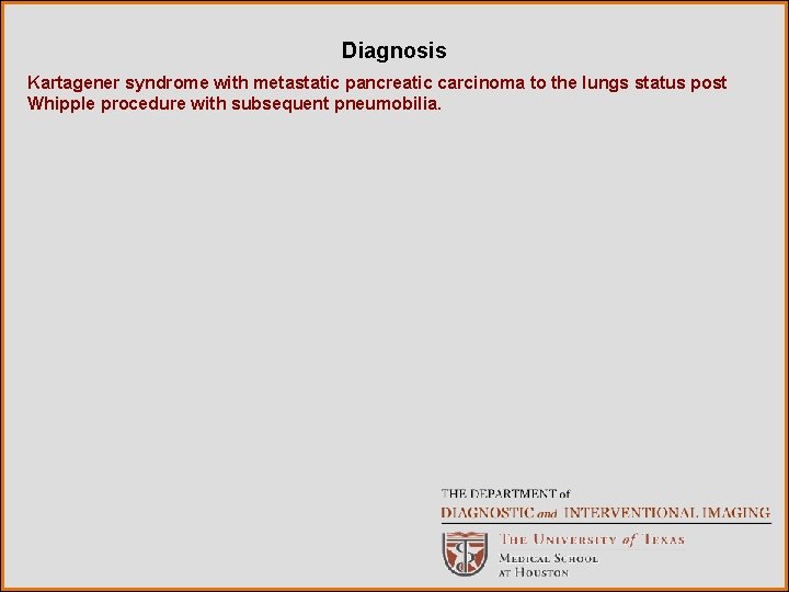 Diagnosis Kartagener syndrome with metastatic pancreatic carcinoma to the lungs status post Whipple procedure