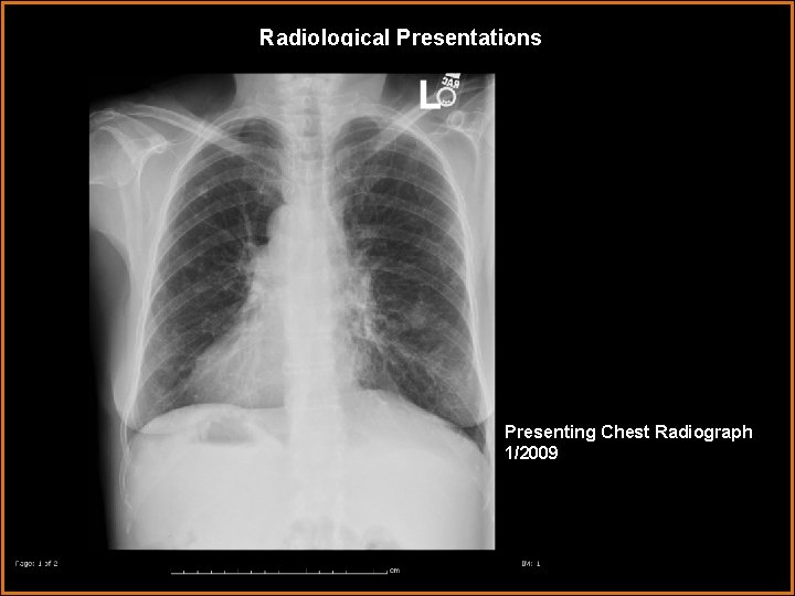 Radiological Presentations Presenting Chest Radiograph 1/2009 