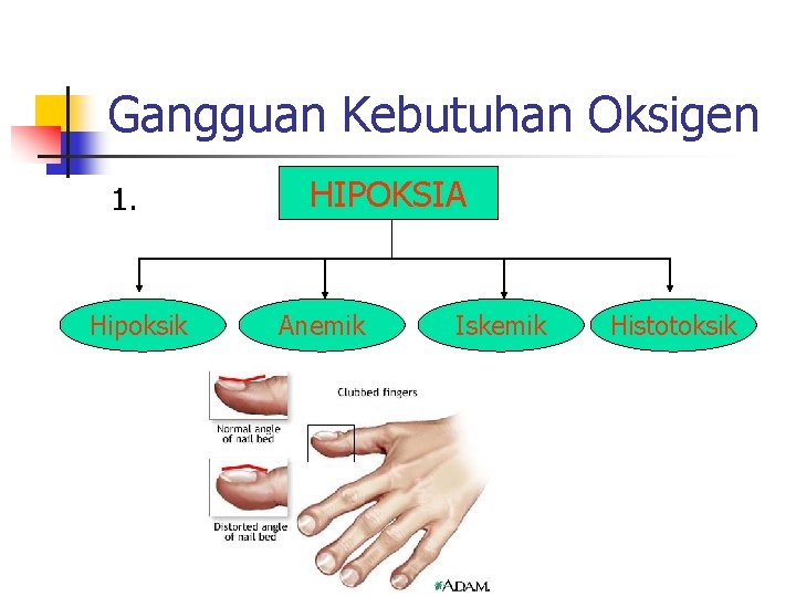 Gangguan Kebutuhan Oksigen 1. Hipoksik HIPOKSIA Anemik Iskemik Histotoksik Gangguan Kebutuhan Oksigen 1. Hipoksik HIPOKSIA Anemik Iskemik Histotoksik