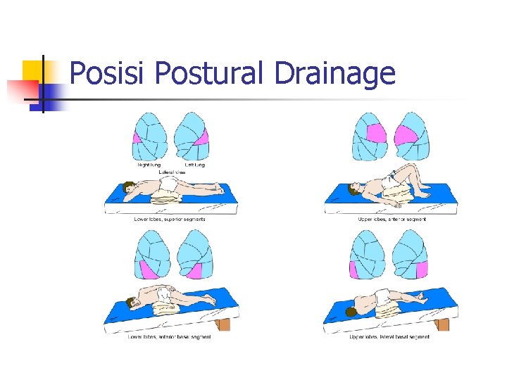 Posisi Postural Drainage Posisi Postural Drainage