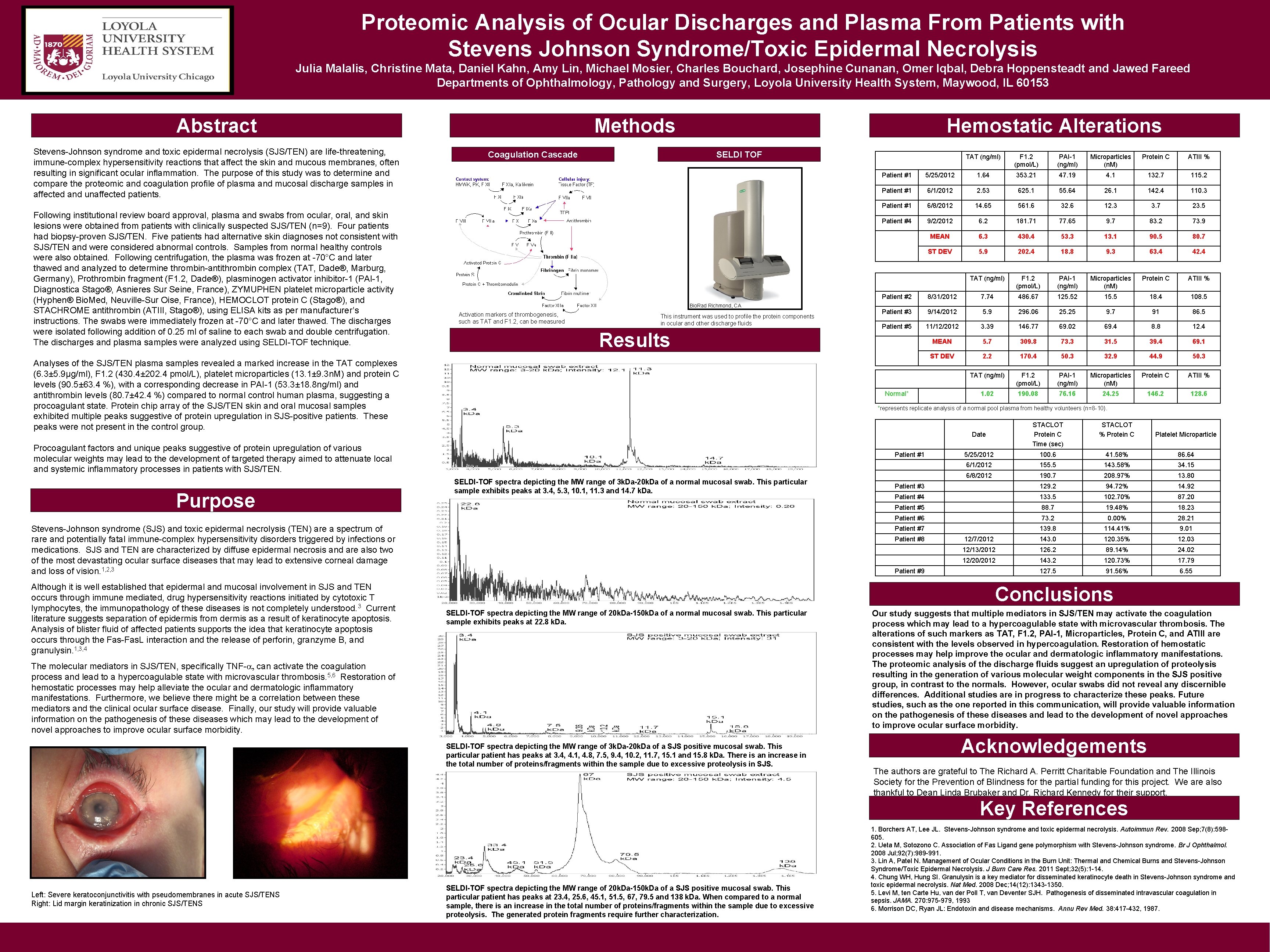 Proteomic Analysis of Ocular Discharges and Plasma From Patients with Stevens Johnson Syndrome/Toxic Epidermal