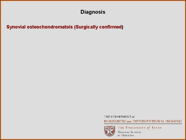 Diagnosis Synovial osteochondromatois (Surgically confirmed) 