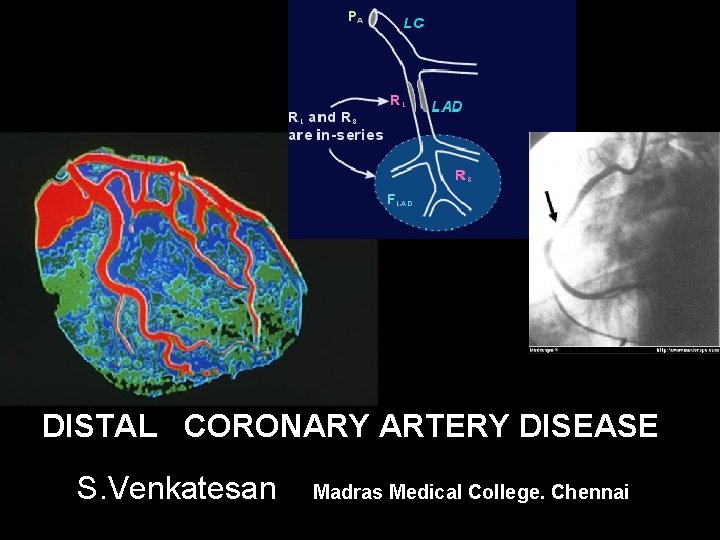 DISTAL CORONARY ARTERY DISEASE S. Venkatesan Madras Medical College. Chennai 