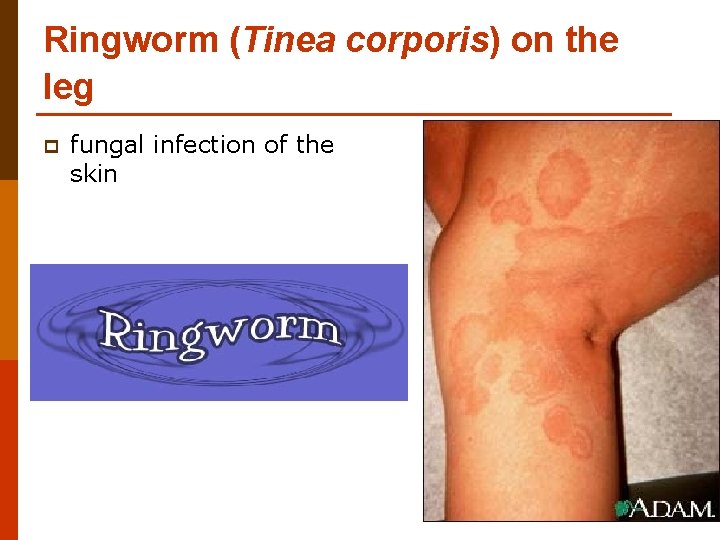 Ringworm (Tinea corporis) on the leg p fungal infection of the skin Ringworm (Tinea corporis) on the leg p fungal infection of the skin