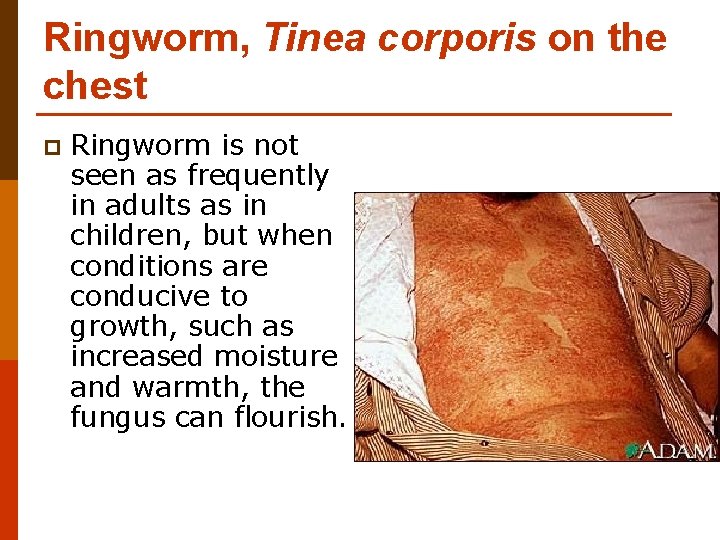 Ringworm, Tinea corporis on the chest p Ringworm is not seen as frequently in Ringworm, Tinea corporis on the chest p Ringworm is not seen as frequently in