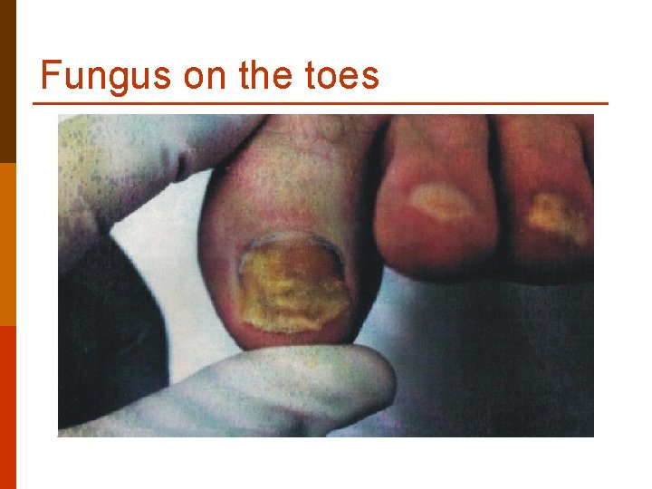 Fungus on the toes Fungus on the toes