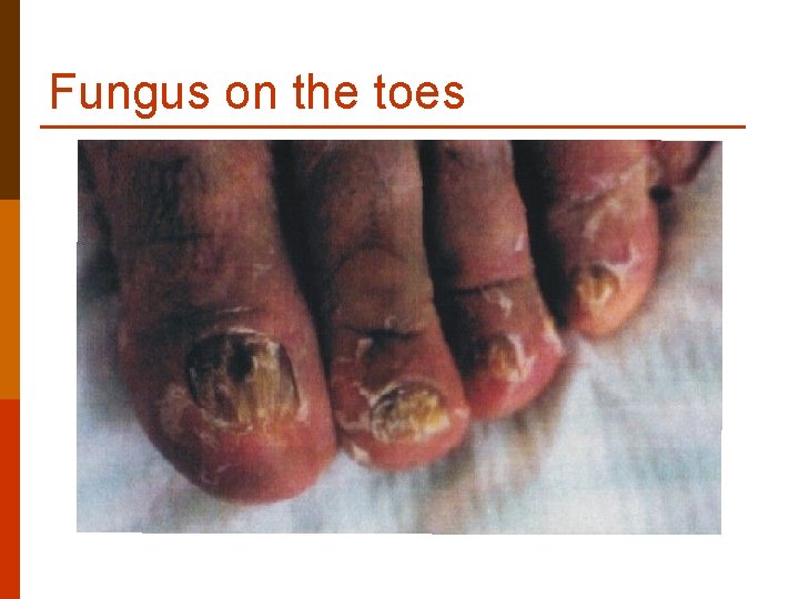 Fungus on the toes Fungus on the toes