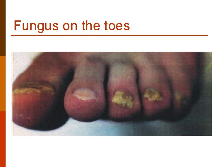 Fungus on the toes Fungus on the toes