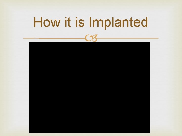 How it is Implanted How it is Implanted