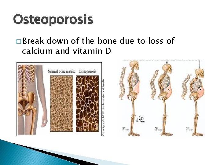 Osteoporosis � Break down of the bone due to loss of calcium and vitamin