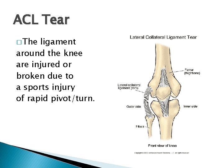 ACL Tear � The ligament around the knee are injured or broken due to