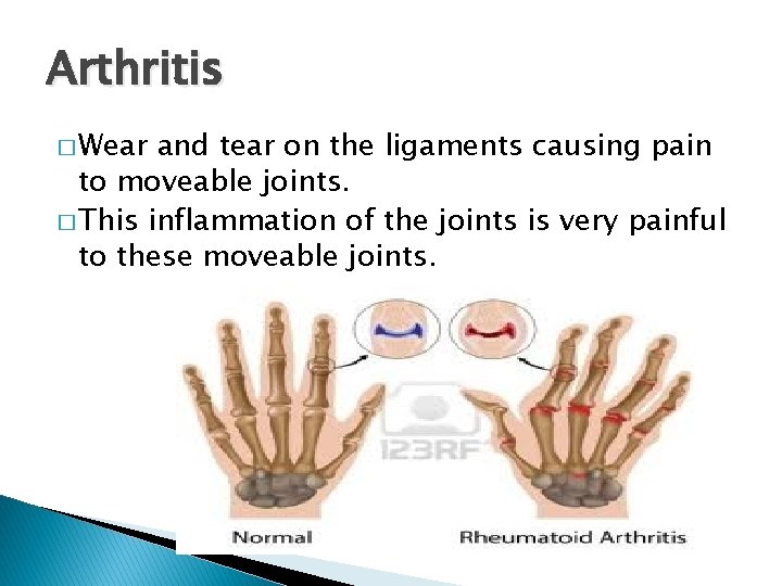 Arthritis � Wear and tear on the ligaments causing pain to moveable joints. �