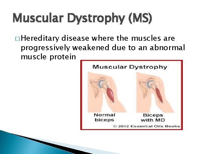 Muscular Dystrophy (MS) � Hereditary disease where the muscles are progressively weakened due to