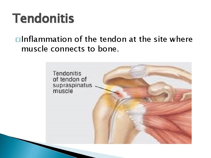 Tendonitis � Inflammation of the tendon at the site where muscle connects to bone.