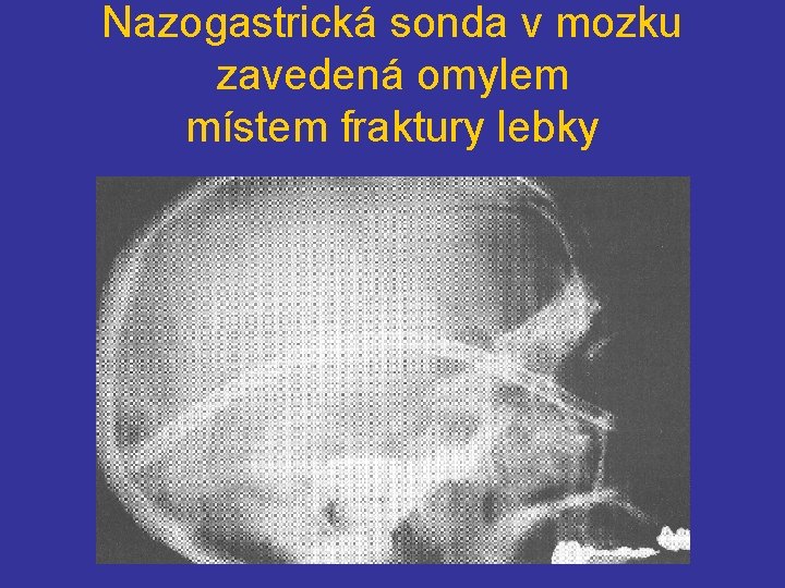 Nazogastrická sonda v mozku zavedená omylem místem fraktury lebky 