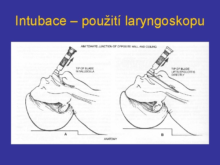 Intubace – použití laryngoskopu 