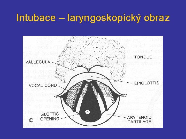 Intubace – laryngoskopický obraz 