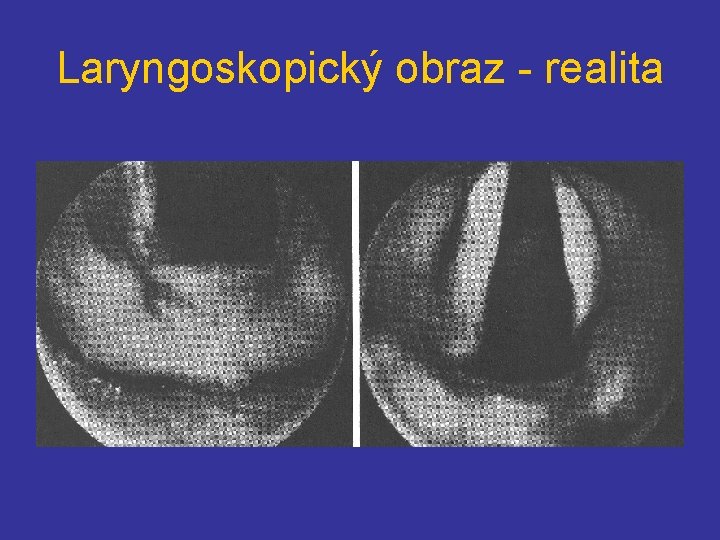 Laryngoskopický obraz - realita 