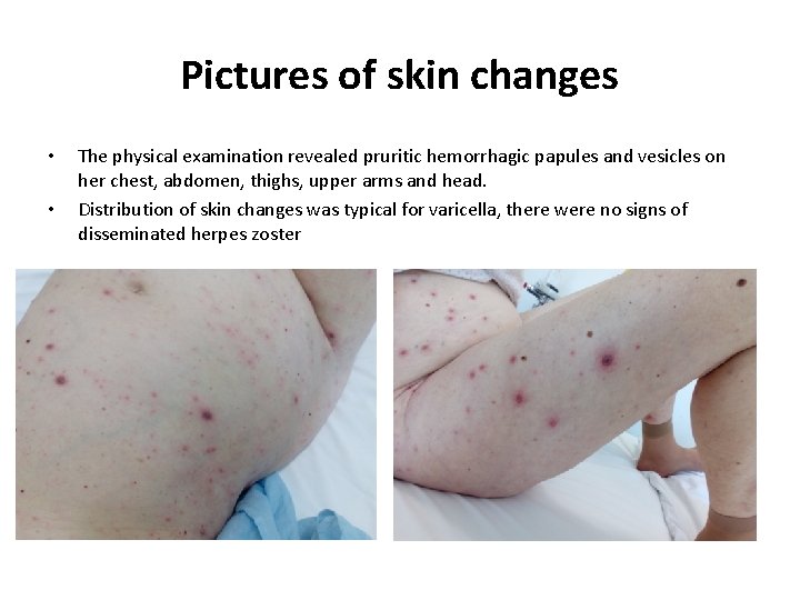 Pictures of skin changes • • The physical examination revealed pruritic hemorrhagic papules and