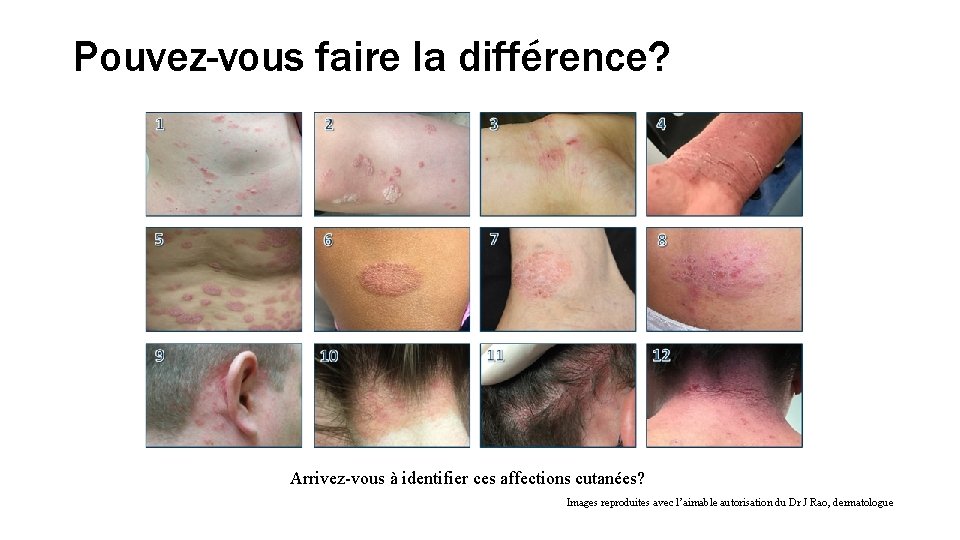 Pouvez-vous faire la différence? Arrivez-vous à identifier ces affections cutanées? Images reproduites avec l’aimable