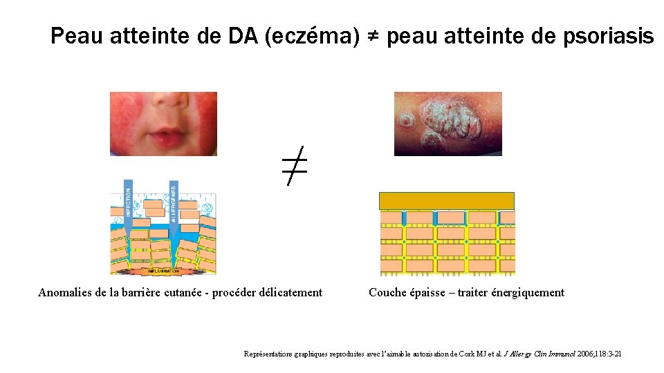 Peau atteinte de DA (eczéma) ≠ peau atteinte de psoriasis ≠ Anomalies de la