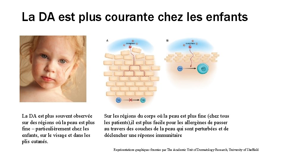 La DA est plus courante chez les enfants La DA est plus souvent observée