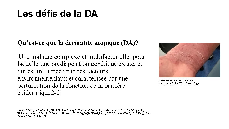 Les défis de la DA Qu’est-ce que la dermatite atopique (DA)? Une maladie complexe