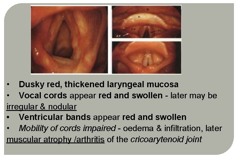 • Dusky red, thickened laryngeal mucosa • Vocal cords appear red and swollen • Dusky red, thickened laryngeal mucosa • Vocal cords appear red and swollen