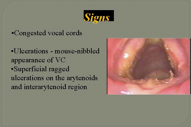 Signs • Congested vocal cords • Ulcerations - mouse-nibbled appearance of VC • Superficial Signs • Congested vocal cords • Ulcerations - mouse-nibbled appearance of VC • Superficial