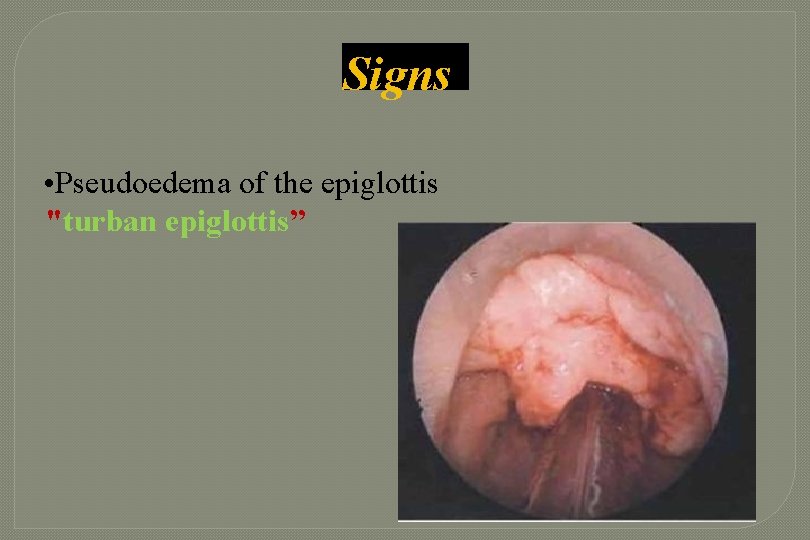 Signs • Pseudoedema of the epiglottis "turban epiglottis” Signs • Pseudoedema of the epiglottis "turban epiglottis”