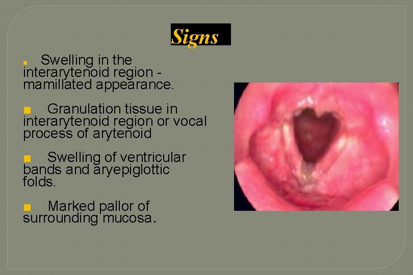 Signs Swelling in the interarytenoid region mamillated appearance. ■ ■ Granulation tissue in interarytenoid Signs Swelling in the interarytenoid region mamillated appearance. ■ ■ Granulation tissue in interarytenoid
