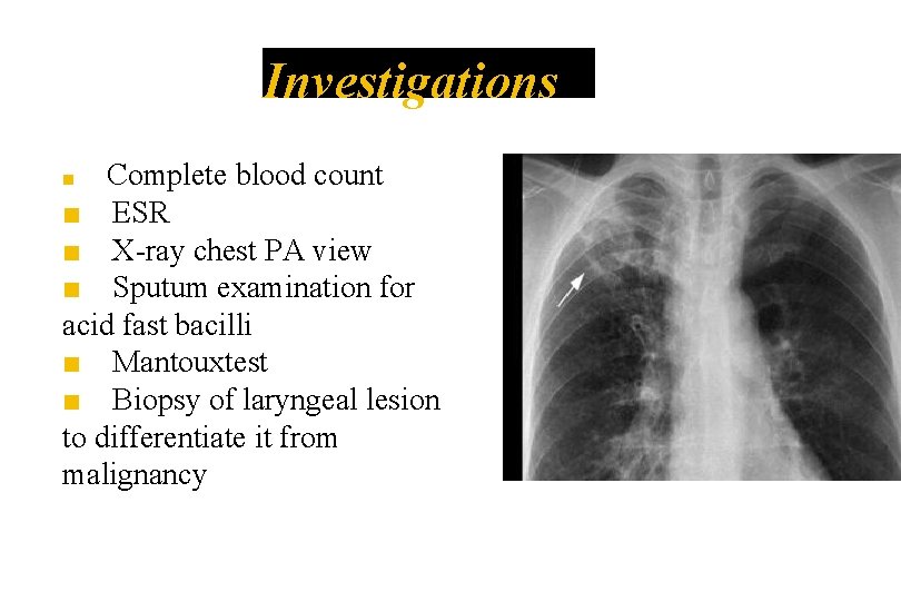 Investigations Complete blood count ■ ESR ■ X-ray chest PA view ■ Sputum examination Investigations Complete blood count ■ ESR ■ X-ray chest PA view ■ Sputum examination
