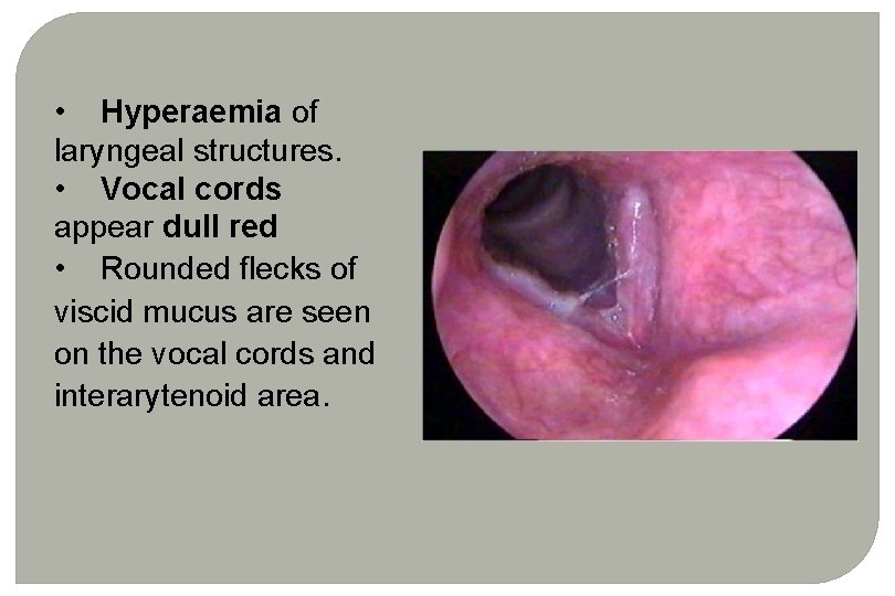 • Hyperaemia of laryngeal structures. • Vocal cords appear dull red • Rounded • Hyperaemia of laryngeal structures. • Vocal cords appear dull red • Rounded