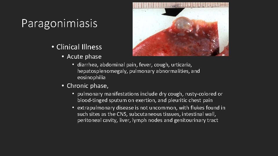 Paragonimiasis • Clinical Illness • Acute phase • diarrhea, abdominal pain, fever, cough, urticaria,