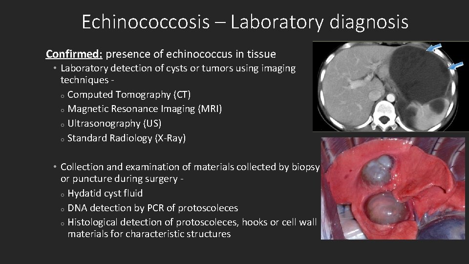 Echinococcosis – Laboratory diagnosis Confirmed: presence of echinococcus in tissue • Laboratory detection of