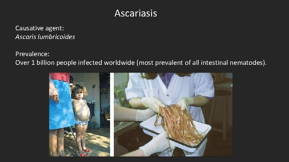 Ascariasis Causative agent: Ascaris lumbricoides Prevalence: Over 1 billion people infected worldwide (most prevalent