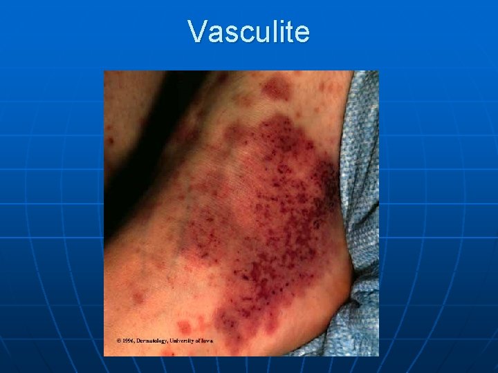 Vasculite 