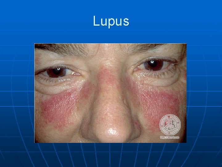 Lupus 