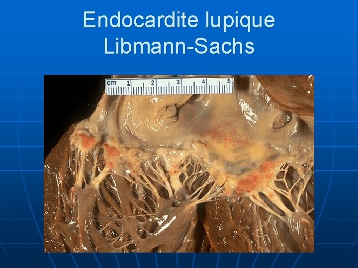 Endocardite lupique Libmann-Sachs 