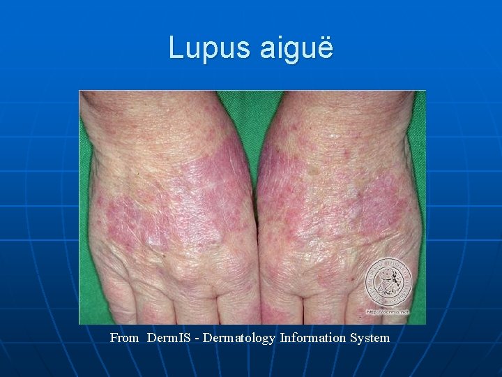 Lupus aiguë From Derm. IS - Dermatology Information System 