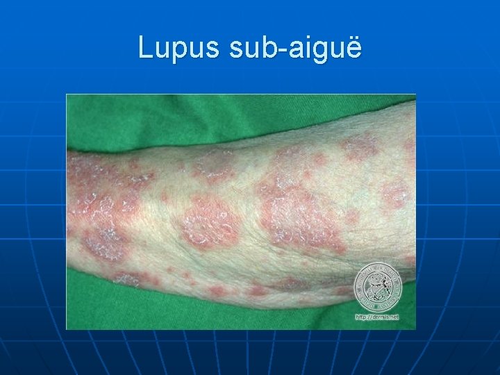 Lupus sub-aiguë 