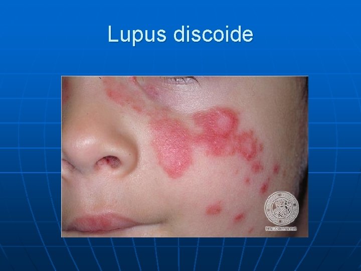 Lupus discoide 