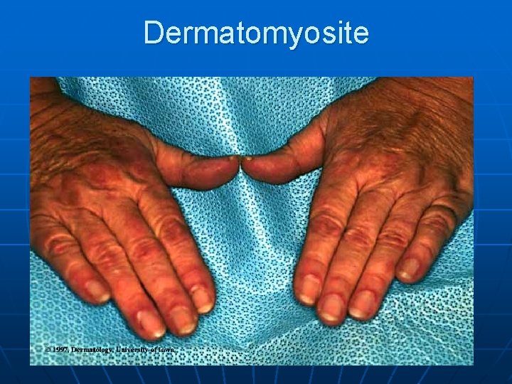 Dermatomyosite 