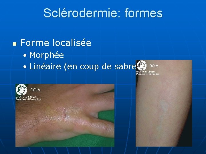 Sclérodermie: formes n Forme localisée • Morphée • Linéaire (en coup de sabre) 