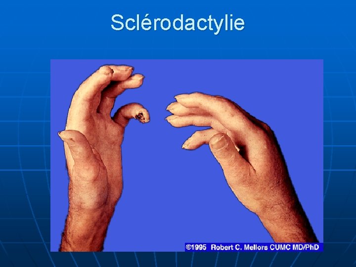 Sclérodactylie 