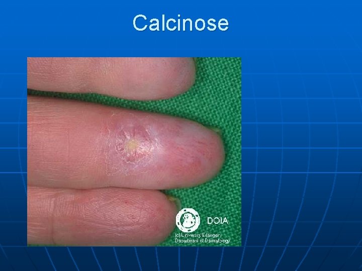 Calcinose 